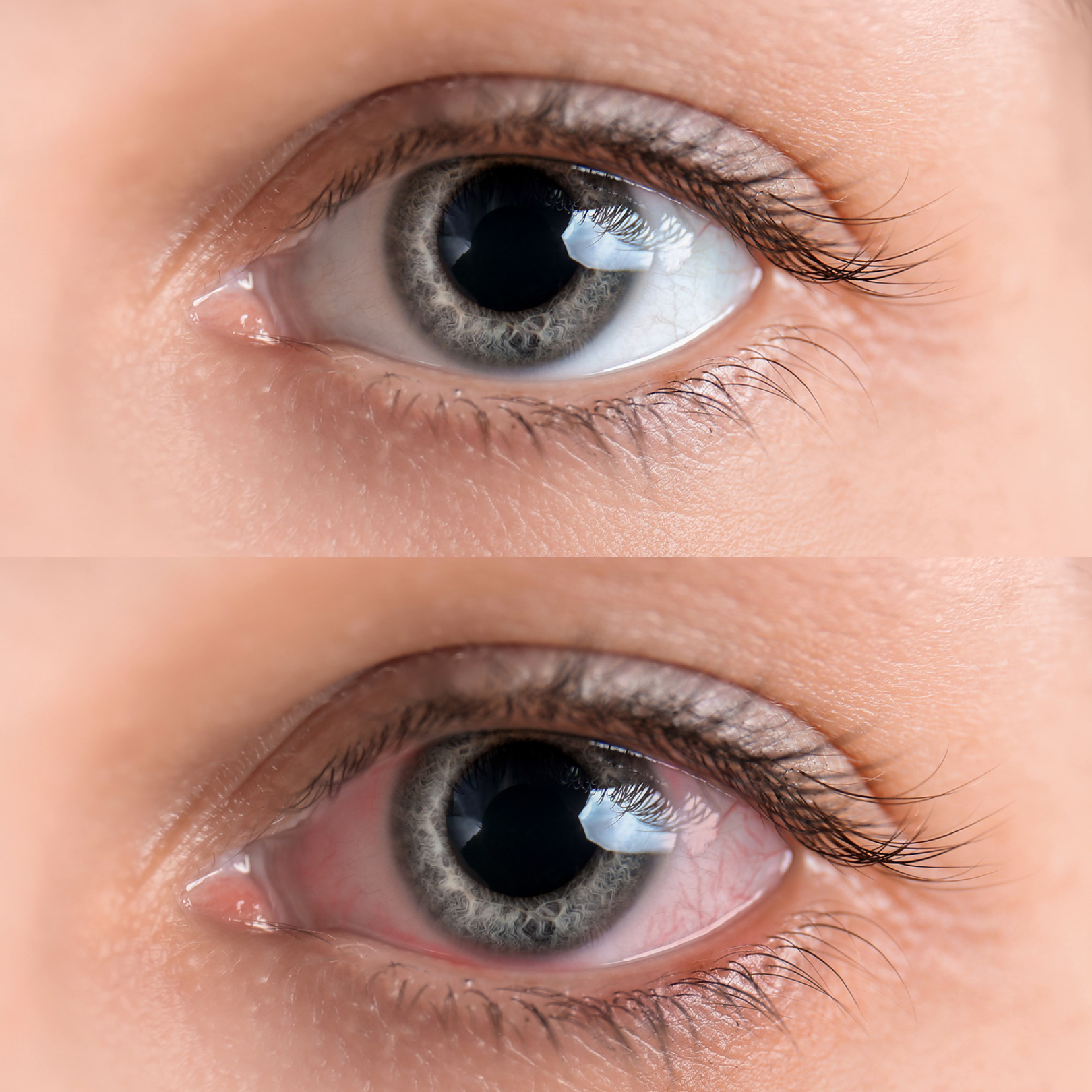 Common Eye Disorders and Diseases